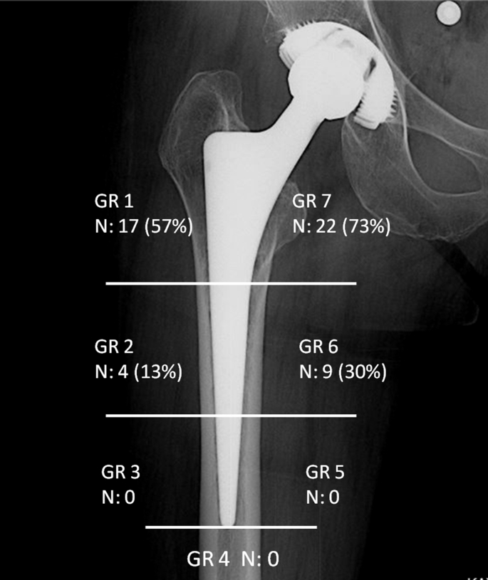 Long term survival analysis of cementless Spotorno femoral stem in ...