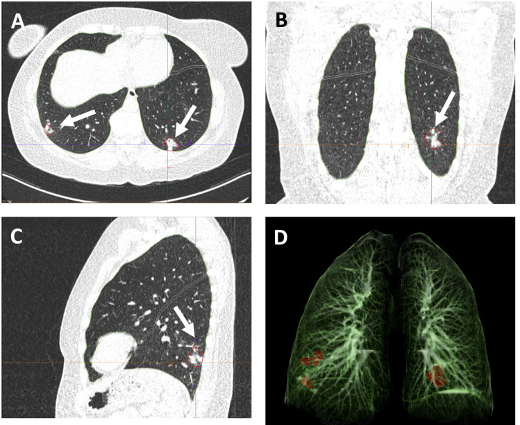 Example images from a 48-year-old female patient with RT-PCR confirmed COVID-19. CT scan was obtained 14 days after the start of symptom onset at ER presentation and show bilateral subpleural areas of consolidation in the lower lobes consistent with limited late-stage COVID-19 (arrows in A,B,C). AI-assisted analysis semi-quantitative CT score of 2/25 and quantitative lung involvement of 0.29%. No manual correction was required. Visual assessment: semi-quantitative CT score of 2/25 and quantitative lung involvement of 1%. 3D reconstruction highlights the areas of consolidation in the lower lobes (D). Window center, -600 HU; window width 1600 HU; slice thickness, 1 mm; and increment, 0.7 mm for all images.