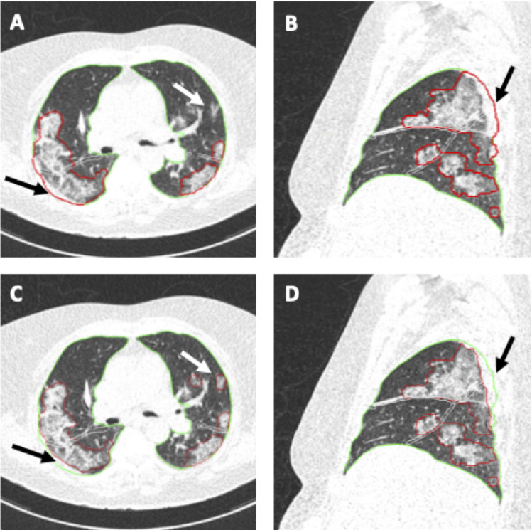 Example images from a 68-year-old female patient with RT-PCR confirmed COVID-19. CT scan was obtained 7 days after the start of symptom onset at ER presentation and show bilateral extensive subpleural areas of ground-glass opacities and consolidation consistent with extensive COVID-19. Automated AI-assisted analysis (A,B) failed to detect small areas of ground-glass opacities in the left upper lobe and included part of the thoracic wall into the area of consolidation in the right upper lobe (arrows in A and B) (semiquantitative CT score 8/25, percentage of lung involvement 23.60%). Reader manual correction added these small areas of ground-glass opacities and corrected the segmentation of the thoracic wall (arrows in C and D) (semiquantitative CT score 9/25, percentage of lung involvement 25.24%). Patient was admitted to the ICU 1 day later. Window center, -600 HU; window width 1600 HU; slice thickness, 1 mm; and increment, 0.7 mm for all images.