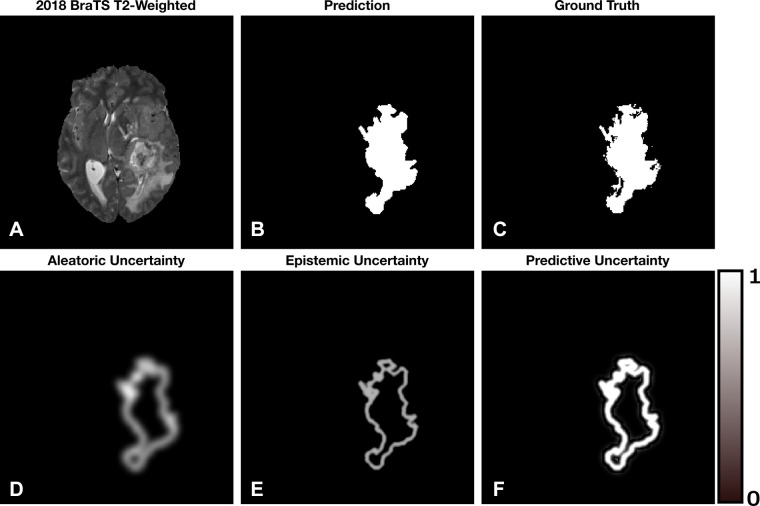 A simulated example of the aleatoric, epistemic, and predictive uncertainties for a segmentation task. Brighter pixels indicate larger uncertainty with range 0–1. (A) Axial T2-weighted MRI section from the 2018 Medical Image Computing and Computer Assisted Intervention Society Multimodal Brain Tumor Image Segmentation dataset (16,17). (B) The hypothetical segmentation output. (C) The ground truth segmentation. (D) Aleatoric uncertainty localized to the boundaries of the segmentation. (E) Epistemic uncertainty localized to the boundary of the segmentation with less ambiguity compared with the aleatoric uncertainty. (F) Predictive uncertainty, which is the addition of (D) and (E). We notice that the model is confident within the interior of the segmented lesion and less so at the boundary.