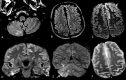 Images of acute encephalopathy in a 60-year-old-man without history of seizures who presented with convulsion. A, B, Fluid-attenuated inversion-recovery images show multifocal areas of hyperintensity in the right cerebellum (arrow in A), left anterior cingular cortex, and superior frontal gyrus (arrows in B). C–E, Diffusion-weighted images show restricted diffusion in the left anterior cingulate cortex and superior frontal gyrus (arrows in C), superior frontal and middle temporal gyrus (arrows in D), and right cerebellum (arrows in E), consistent with cerebellar diaschisis. F, MRI scan obtained with gradient-echo sequence shows no hemosiderin deposits.