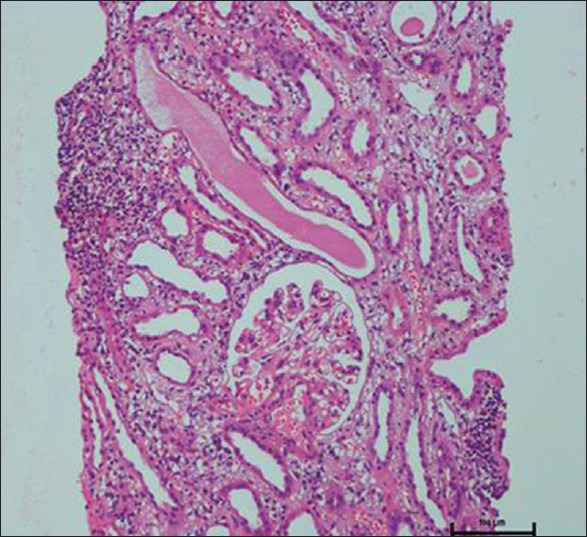 Acute Interstitial Nephritis Due To Proton Pump Inhibitors PMC acute-interstitial-nephritis-due-to-proton-pump-inhibitors-pmc