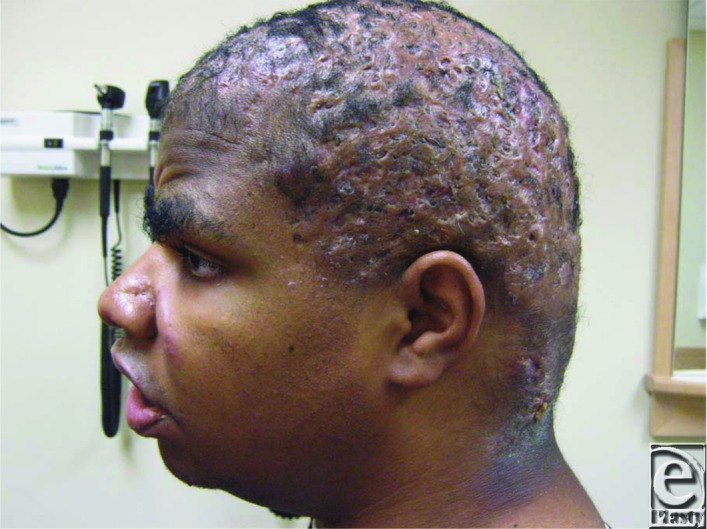 Dissecting Cellulitis of the Scalp: Case Discussion, Unique ...