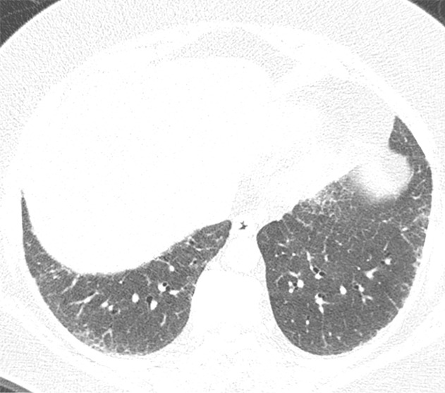 CT-histologic correlation in nonspecific interstitial pneumonia. (a) Axial CT image shows predominant ground-glass abnormality, with mild subpleural reticular abnormality. (b) Histologic image shows a diffuse homogeneous process with expansion of the alveolar septa by chronic inflammation and patchy interstitial scarring, unassociated with honeycomb change or substantial remodeling of the underlying lung architecture. In contrast to UIP, the abnormality is temporally homogeneous. (Hematoxylin-eosin stain) (Histologic image courtesy of Rosane Duarte Achcar, MD, National Jewish Health.)