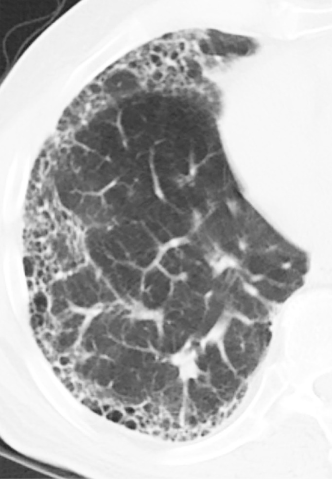 Honeycomb cysts and paraseptal emphysema. (a) Zoomed view of axial CT demonstrates classic honeycomb cyst formation with stacking subpleural cysts and associated adjacent fibrosis in a patient with idiopathic pulmonary fibrosis. (b) Zoomed view of axial CT in a different patient demonstrates paraseptal emphysema, characterized by a single layer of subpleural cysts, without any evidence of associated fibrosis in a patient with a history of marijuana cigarette smoking. The cysts of paraseptal emphysema are typically more than 1.0 cm in diameter, larger than honeycomb cysts, and have thinner walls.