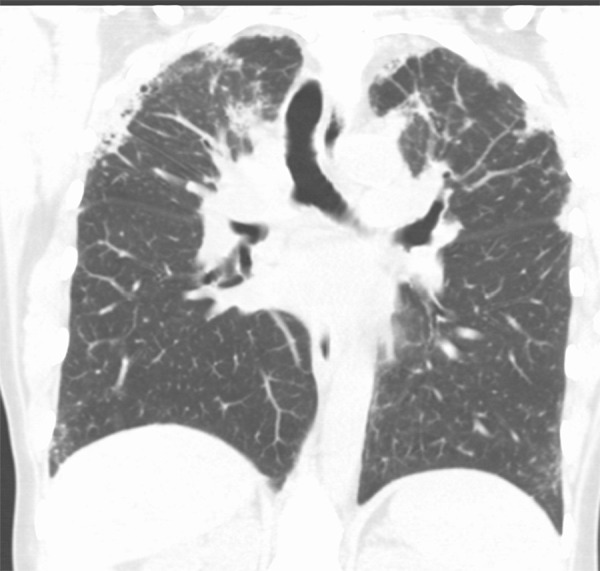 Pleuroparenchymal fibroelastosis in a 48-year-old woman. Coronal CT image shows dense subpleural consolidative abnormality with traction bronchiectasis and marked upper lobe volume loss.