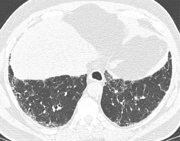 Probable usual interstitial pneumonia pattern. (a–c) Axial inspiratory CT images demonstrate peripheral and basilar-predominant reticular abnormality, with mild peripheral traction bronchiectasis or bronchiolectasis, but without associated honeycombing, making this a probable UIP pattern based on Fleischner and American Thoracic Society guidelines. (d) Coronal inspiratory CT scan confirms the lower lung–predominant distribution of disease in the craniocaudal plane.