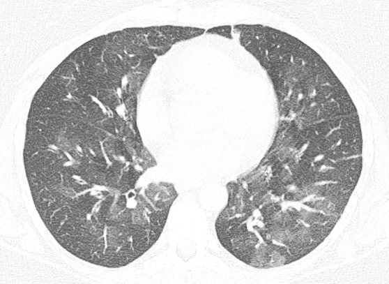 Mosaic attenuation and air trapping. (a) Axial inspiratory CT scan demonstrates mosaic attenuation due to ground-glass opacity in a case of respiratory bronchiolitis-associated interstitial lung disease. (b) Axial inspiratory CT scan demonstrates mosaic attenuation due to small airways disease in a case of constrictive bronchiolitis. (c) Axial expiratory CT imaging (same patient as b) demonstrates accentuation of the areas of hyperlucency from the adjacent lung, confirming small airways disease as the cause of mosaic attenuation.