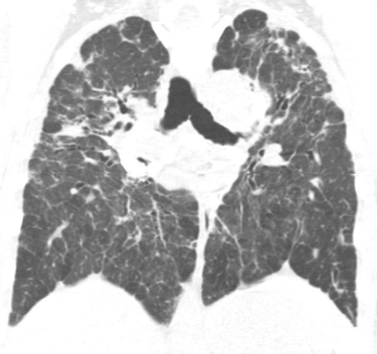 Advanced fibrotic sarcoidosis. (a–c) Axial inspiratory CT and (d) coronal inspiratory CT images demonstrate mid to upper lung–predominant pulmonary fibrosis with marked architectural distortion, associated lung nodularity, and some mosaic attenuation. Note also the calcified mediastinal lymph nodes. This case would be categorized as most consistent with a nonidiopathic pulmonary fibrosis diagnosis based on these features.