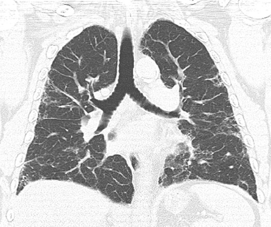 Probable usual interstitial pneumonia pattern. (a–c) Axial inspiratory CT images demonstrate peripheral and basilar-predominant reticular abnormality, with mild peripheral traction bronchiectasis or bronchiolectasis, but without associated honeycombing, making this a probable UIP pattern based on Fleischner and American Thoracic Society guidelines. (d) Coronal inspiratory CT scan confirms the lower lung–predominant distribution of disease in the craniocaudal plane.