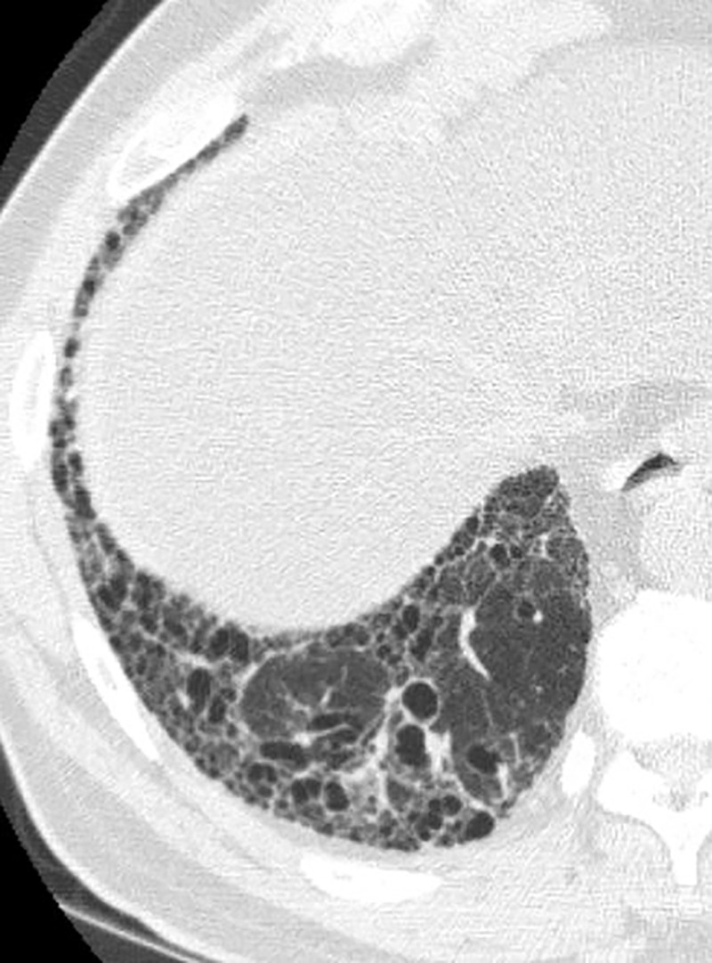 Reticular abnormality and architectural distortion. Reticular abnormality consists of a fine network or mesh of overlapping linear lines within the secondary pulmonary lobule. It is this network or mesh that separates reticular abnormality from ground-glass opacities, which are more homogeneous (see Figure 5). This case also shows associated architectural distortion with the normal secondary pulmonary lobules demonstrating tethering and warping of the normal hexagonal appearance. There is also mild honeycombing best seen in the costophrenic sulcus.