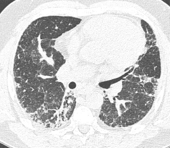 CT pattern indeterminate for usual interstitial pneumonia. (a–c) Axial inspiratory CT images demonstrate peripheral and lower lung–predominant reticular abnormality with architectural distortion, including traction bronchiectasis. However, there is slightly more ground-glass abnormality than typically seen with a confident diagnosis of a usual interstitial pneumonia pattern, and the reticular abnormality extends along the bronchovascular bundles rather than being confined to the subpleural lung.