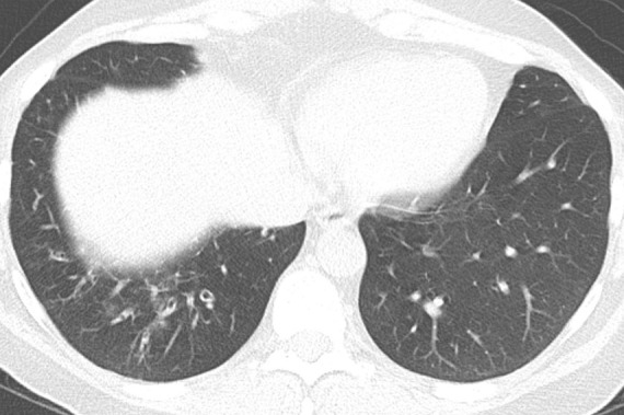 Comparison of traction bronchiectasis with bronchiectasis from chronic airway inflammation. (a) Axial CT scan demonstrates traction bronchiectasis in a patient with fibrotic nonspecific interstitial pneumonia. Note the substantial reticular abnormality and architectural distortion adjacent to the irregular dilated airways. (b) Axial CT scan demonstrates cylindrical bronchiectasis in the right lower lobe of a patient with underlying immunodeficiency. In contrast to traction bronchiectasis, this postinflammatory bronchiectasis lacks adjacent fibrosis and “tethering” of the airways. There are also associated findings of bronchial wall thickening and mucoid impaction.