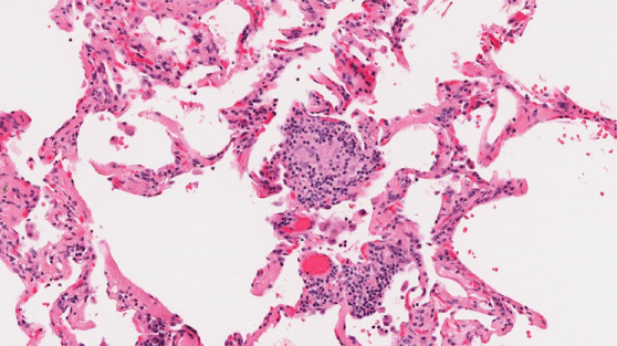 CT-histologic correlation in fibrotic hypersensitivity pneumonitis (HP). (a) Coronal CT image shows lower lung–predominant reticular and ground-glass abnormality. The findings of mosaic attenuation and peribronchovascular predominance are highly suggestive of fibrotic HP. (b) Photomicrograph from histologic examination shows centrilobular scarring compatible with fibrotic HP. (Hematoxylin-eosin stain) (c) Peribronchiolar poorly formed nonnecrotizing granulomas are also present, highly suggestive of HP. (Hematoxylin-eosin stain) (Histologic images courtesy of Rosane Duarte Achcar, MD, National Jewish Health.)