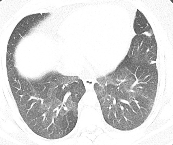 Mosaic attenuation and air trapping. (a) Axial inspiratory CT scan demonstrates mosaic attenuation due to ground-glass opacity in a case of respiratory bronchiolitis-associated interstitial lung disease. (b) Axial inspiratory CT scan demonstrates mosaic attenuation due to small airways disease in a case of constrictive bronchiolitis. (c) Axial expiratory CT imaging (same patient as b) demonstrates accentuation of the areas of hyperlucency from the adjacent lung, confirming small airways disease as the cause of mosaic attenuation.