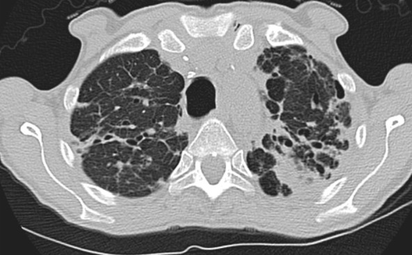 Advanced fibrotic sarcoidosis. (a–c) Axial inspiratory CT and (d) coronal inspiratory CT images demonstrate mid to upper lung–predominant pulmonary fibrosis with marked architectural distortion, associated lung nodularity, and some mosaic attenuation. Note also the calcified mediastinal lymph nodes. This case would be categorized as most consistent with a nonidiopathic pulmonary fibrosis diagnosis based on these features.