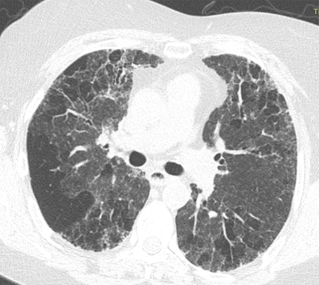 Fibrotic hypersensitivity pneumonitis. (a–c) Axial inspiratory CT scans demonstrate substantial ground-glass abnormality, mild centrilobular nodularity, and moderate mosaic attenuation, in addition to peribronchovascular and lower lung–predominant fibrosis. (d–f) Axial expiratory CT images confirm air trapping as the cause of mosaic attenuation. The degree of ground-glass abnormality, the degree of air trapping, and the peribronchovascular predominance of fibrosis would result in this case being categorized as most consistent with a nonidiopathic pulmonary fibrosis diagnosis.