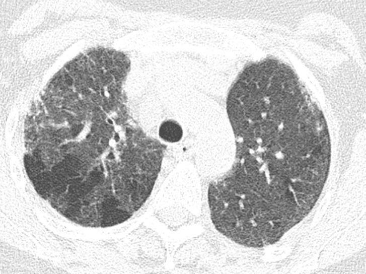 Fibrotic hypersensitivity pneumonitis. (a–c) Axial inspiratory CT scans demonstrate substantial ground-glass abnormality, mild centrilobular nodularity, and moderate mosaic attenuation, in addition to peribronchovascular and lower lung–predominant fibrosis. (d–f) Axial expiratory CT images confirm air trapping as the cause of mosaic attenuation. The degree of ground-glass abnormality, the degree of air trapping, and the peribronchovascular predominance of fibrosis would result in this case being categorized as most consistent with a nonidiopathic pulmonary fibrosis diagnosis.