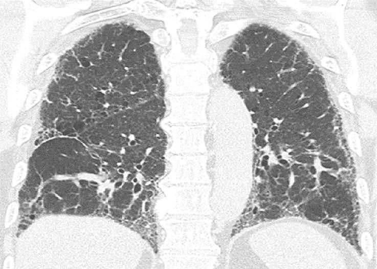 Usual interstitial pneumonia pattern. (a–d) Axial inspiratory CT images demonstrate peripheral and basilar-predominant reticular abnormality, with associated traction bronchiectasis and honeycombing. This is a usual interstitial pneumonia pattern based on Fleischner and American Thoracic Society guidelines. (e) Coronal inspiratory CT scan confirms the lower lung–predominant distribution of disease in the craniocaudal plane.