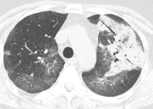 Consolidation. Left upper lobe consolidation in a patient with infectious pneumonia. The lung attenuation is diffusely increased, with air bronchograms, and the underlying vessels are completely obscured by the airspace opacity. Ground-glass opacities are seen in the nonconsolidated lung bilaterally. This finding is not a feature typical of usual interstitial pneumonia or idiopathic pulmonary fibrosis but can be seen in the setting of overlapping or superimposed disease.