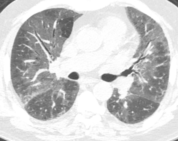 Ground-glass opacities. Axial CT image demonstrates homogeneous areas of increased lung attenuation in which the increased opacity does not obscure the underlying bronchial and vascular structures. This finding is not a feature typical of usual interstitial pneumonia or idiopathic pulmonary fibrosis but can be seen in the setting of overlapping or superimposed disease.