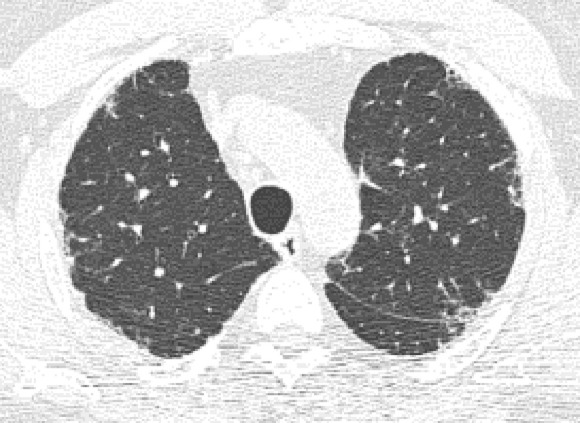 Probable usual interstitial pneumonia pattern. (a–c) Axial inspiratory CT images demonstrate peripheral and basilar-predominant reticular abnormality, with mild peripheral traction bronchiectasis or bronchiolectasis, but without associated honeycombing, making this a probable UIP pattern based on Fleischner and American Thoracic Society guidelines. (d) Coronal inspiratory CT scan confirms the lower lung–predominant distribution of disease in the craniocaudal plane.