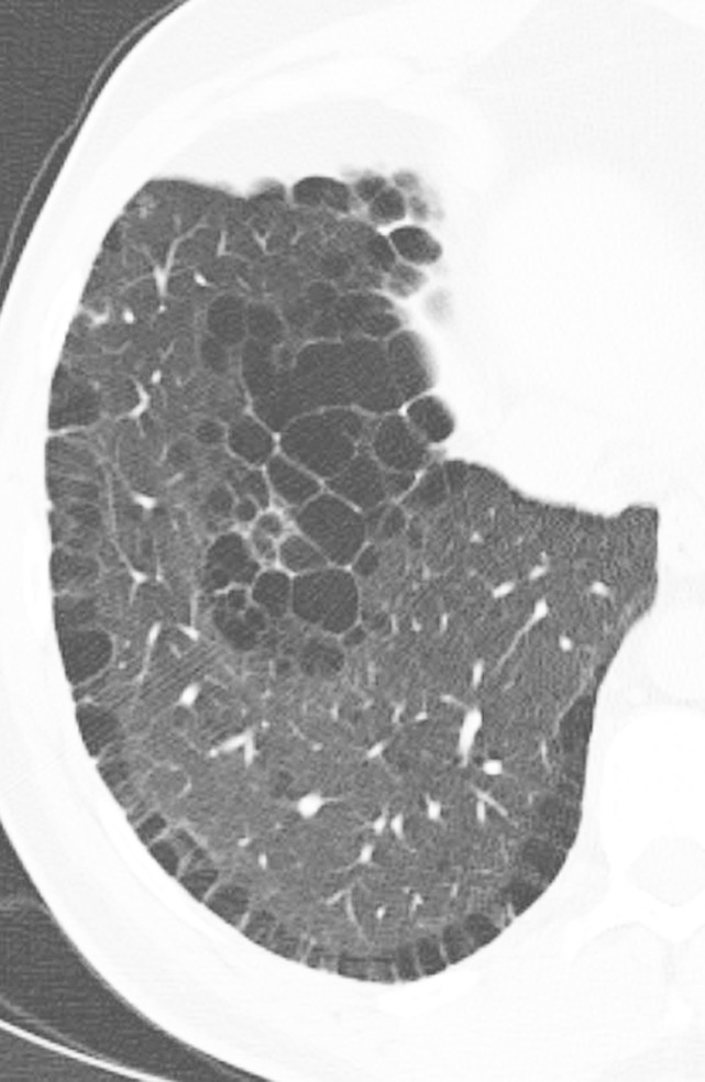 Honeycomb cysts and paraseptal emphysema. (a) Zoomed view of axial CT demonstrates classic honeycomb cyst formation with stacking subpleural cysts and associated adjacent fibrosis in a patient with idiopathic pulmonary fibrosis. (b) Zoomed view of axial CT in a different patient demonstrates paraseptal emphysema, characterized by a single layer of subpleural cysts, without any evidence of associated fibrosis in a patient with a history of marijuana cigarette smoking. The cysts of paraseptal emphysema are typically more than 1.0 cm in diameter, larger than honeycomb cysts, and have thinner walls.