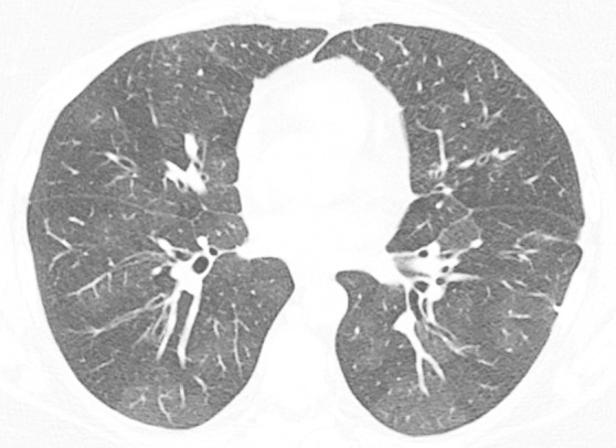 Mosaic attenuation and air trapping. (a) Axial inspiratory CT scan demonstrates mosaic attenuation due to ground-glass opacity in a case of respiratory bronchiolitis-associated interstitial lung disease. (b) Axial inspiratory CT scan demonstrates mosaic attenuation due to small airways disease in a case of constrictive bronchiolitis. (c) Axial expiratory CT imaging (same patient as b) demonstrates accentuation of the areas of hyperlucency from the adjacent lung, confirming small airways disease as the cause of mosaic attenuation.