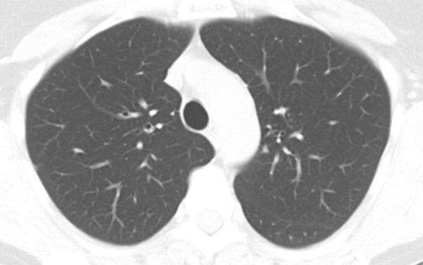 Axial thin-section CT scans in a healthy patient. (a) Inspiratory examination reconstructed with 5-mm thick sections and soft-tissue reconstruction demonstrates relative loss of definition of the interlobular septa and secondary pulmonary lobule. (b) Inspiratory sequence reconstructed with 1-mm thin sections and moderate edge-enhancing kernel reconstruction shows normal appearance. (c) Expiratory imaging shows bowing of the posterior tracheal wall and diffuse mildly heterogeneous increase in lung attenuation. Note that mild heterogeneous lung attenuation is normal.