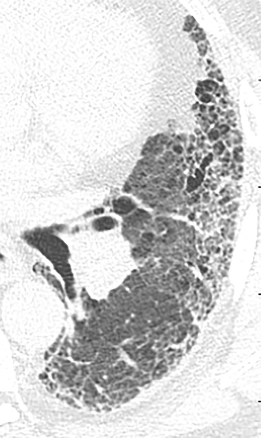 Acute exacerbation of idiopathic pulmonary fibrosis. (a) Zoomed view of axial CT demonstrates a probable usual interstitial pneumonia pattern in a patient with idiopathic pulmonary fibrosis. (b) Zoomed view of axial CT obtained after rapid deterioration in symptoms demonstrates CT findings of acute exacerbation with progression of reticular abnormality and marked new superimposed ground-glass opacity. Other causes of airspace disease including infection were clinically excluded. (c) Zoomed view of axial CT obtained after resolution of acute exacerbation confirms that the background fibrosis has substantially progressed.