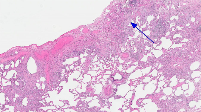 CT-histologic correlation in usual interstitial pneumonia. (a) Coronal CT image shows reticular abnormality and mild honeycombing with subpleural and lower lung predominance, typical of usual interstitial pneumonia. (b) Photomicrograph from histologic examination shows remodeling of the lung architecture by predominantly subpleural and paraseptal dense fibrosis, with scattered fibroblastic foci (blue arrow). Areas of normal lung are also seen, mainly in the centrilobular region, indicating temporal heterogeneity. (Histologic image courtesy of Rosane Duarte Achcar, MD, National Jewish Health.)