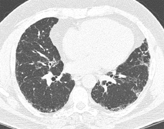 Probable usual interstitial pneumonia pattern. (a–c) Axial inspiratory CT images demonstrate peripheral and basilar-predominant reticular abnormality, with mild peripheral traction bronchiectasis or bronchiolectasis, but without associated honeycombing, making this a probable UIP pattern based on Fleischner and American Thoracic Society guidelines. (d) Coronal inspiratory CT scan confirms the lower lung–predominant distribution of disease in the craniocaudal plane.