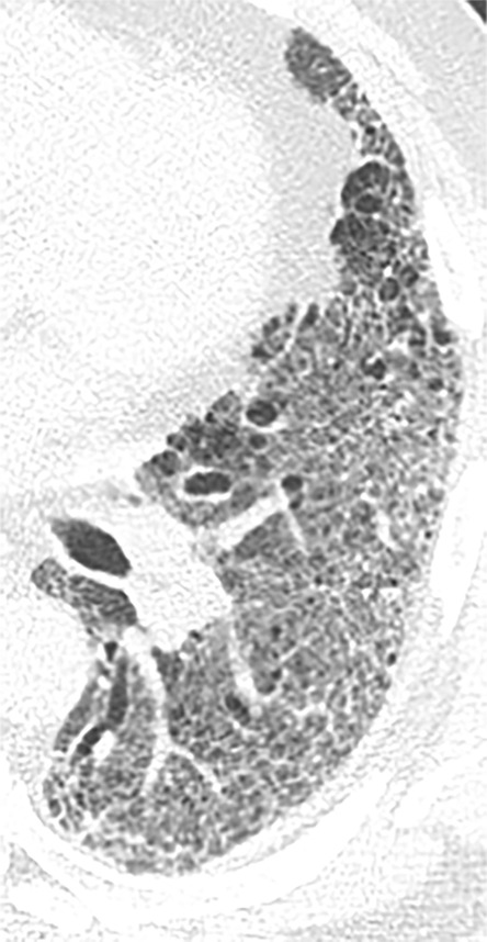 Acute exacerbation of idiopathic pulmonary fibrosis. (a) Zoomed view of axial CT demonstrates a probable usual interstitial pneumonia pattern in a patient with idiopathic pulmonary fibrosis. (b) Zoomed view of axial CT obtained after rapid deterioration in symptoms demonstrates CT findings of acute exacerbation with progression of reticular abnormality and marked new superimposed ground-glass opacity. Other causes of airspace disease including infection were clinically excluded. (c) Zoomed view of axial CT obtained after resolution of acute exacerbation confirms that the background fibrosis has substantially progressed.