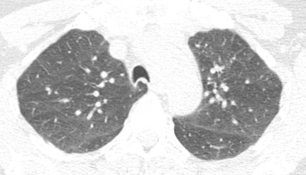 Axial thin-section CT scans in a healthy patient. (a) Inspiratory examination reconstructed with 5-mm thick sections and soft-tissue reconstruction demonstrates relative loss of definition of the interlobular septa and secondary pulmonary lobule. (b) Inspiratory sequence reconstructed with 1-mm thin sections and moderate edge-enhancing kernel reconstruction shows normal appearance. (c) Expiratory imaging shows bowing of the posterior tracheal wall and diffuse mildly heterogeneous increase in lung attenuation. Note that mild heterogeneous lung attenuation is normal.