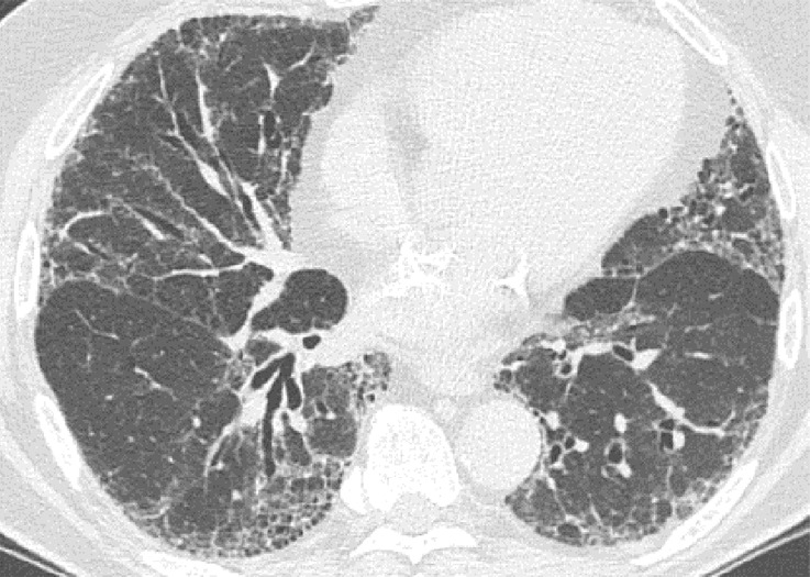 Usual interstitial pneumonia pattern. (a–d) Axial inspiratory CT images demonstrate peripheral and basilar-predominant reticular abnormality, with associated traction bronchiectasis and honeycombing. This is a usual interstitial pneumonia pattern based on Fleischner and American Thoracic Society guidelines. (e) Coronal inspiratory CT scan confirms the lower lung–predominant distribution of disease in the craniocaudal plane.