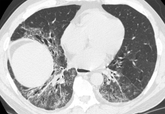 Comparison of traction bronchiectasis with bronchiectasis from chronic airway inflammation. (a) Axial CT scan demonstrates traction bronchiectasis in a patient with fibrotic nonspecific interstitial pneumonia. Note the substantial reticular abnormality and architectural distortion adjacent to the irregular dilated airways. (b) Axial CT scan demonstrates cylindrical bronchiectasis in the right lower lobe of a patient with underlying immunodeficiency. In contrast to traction bronchiectasis, this postinflammatory bronchiectasis lacks adjacent fibrosis and “tethering” of the airways. There are also associated findings of bronchial wall thickening and mucoid impaction.