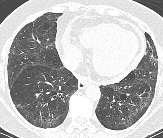 Nonspecific interstitial pneumonia. (a) Axial CT scan demonstrates fibrotic nonspecific interstitial pneumonia early in the disease course with lower lung fibrosis and ground-glass opacity with some subpleural sparing. (b) Axial CT scan 10 years later demonstrates substantial progression of the pulmonary fibrosis, which now demonstrates increased reticular abnormality, less ground-glass abnormality, and more traction bronchiectasis. Understanding the evolution of the disease by reviewing the prior imaging is critical in these cases.