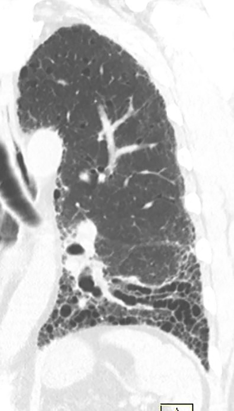 Traction bronchiectasis and bronchiolectasis. Zoomed view of coronal CT demonstrates continuity of dilated irregular airways with the more central bronchi (traction bronchiectasis and bronchiolectasis) in a patient with fibrotic nonspecific interstitial pneumonia.