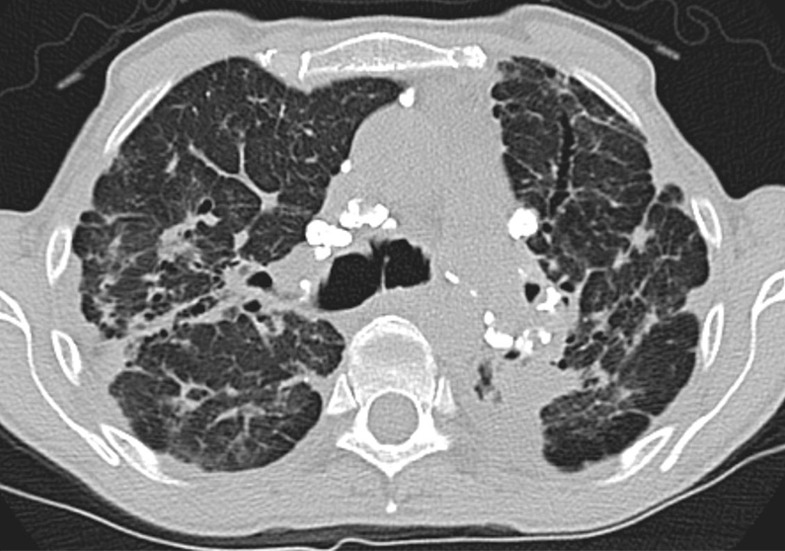 Advanced fibrotic sarcoidosis. (a–c) Axial inspiratory CT and (d) coronal inspiratory CT images demonstrate mid to upper lung–predominant pulmonary fibrosis with marked architectural distortion, associated lung nodularity, and some mosaic attenuation. Note also the calcified mediastinal lymph nodes. This case would be categorized as most consistent with a nonidiopathic pulmonary fibrosis diagnosis based on these features.