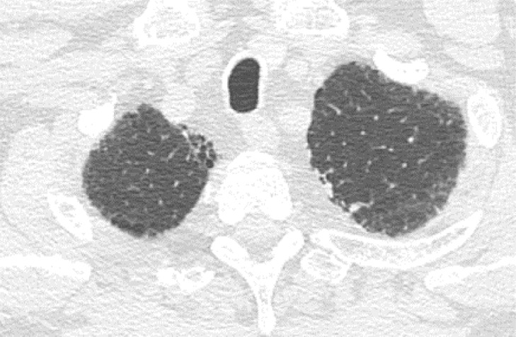 Usual interstitial pneumonia pattern. (a–d) Axial inspiratory CT images demonstrate peripheral and basilar-predominant reticular abnormality, with associated traction bronchiectasis and honeycombing. This is a usual interstitial pneumonia pattern based on Fleischner and American Thoracic Society guidelines. (e) Coronal inspiratory CT scan confirms the lower lung–predominant distribution of disease in the craniocaudal plane.