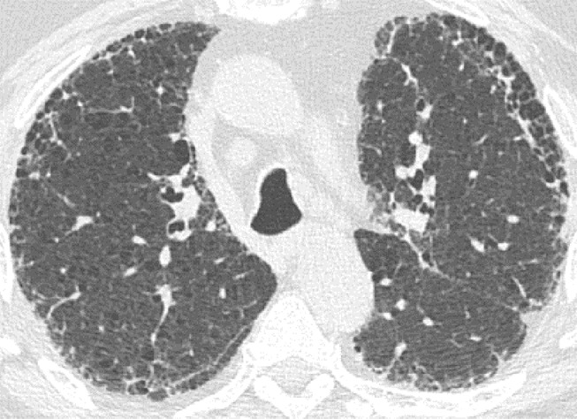 Usual interstitial pneumonia pattern. (a–d) Axial inspiratory CT images demonstrate peripheral and basilar-predominant reticular abnormality, with associated traction bronchiectasis and honeycombing. This is a usual interstitial pneumonia pattern based on Fleischner and American Thoracic Society guidelines. (e) Coronal inspiratory CT scan confirms the lower lung–predominant distribution of disease in the craniocaudal plane.