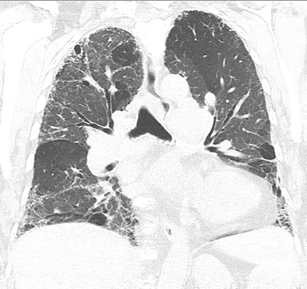 CT pattern most consistent with a nonidiopathic pulmonary fibrosis diagnosis. Coronal CT scan demonstrates pulmonary fibrosis but with substantial upper lung reticular opacities and architectural distortion in addition to ground-glass abnormality and mosaic attenuation. This combination points to chronic hypersensitivity pneumonitis as the likely diagnosis rather than idiopathic pulmonary fibrosis.