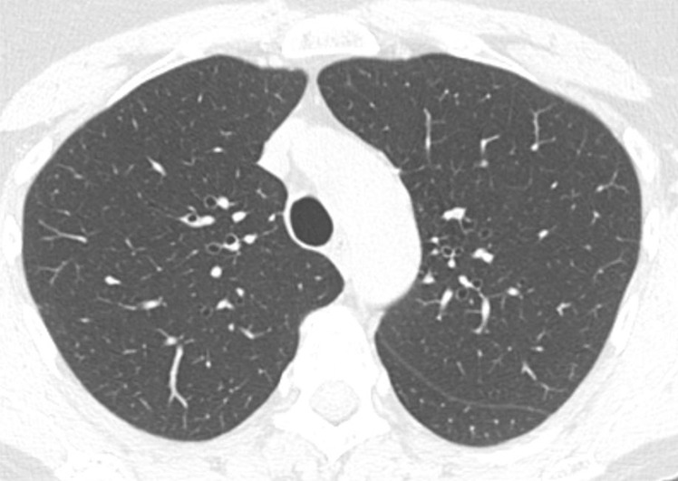 Axial thin-section CT scans in a healthy patient. (a) Inspiratory examination reconstructed with 5-mm thick sections and soft-tissue reconstruction demonstrates relative loss of definition of the interlobular septa and secondary pulmonary lobule. (b) Inspiratory sequence reconstructed with 1-mm thin sections and moderate edge-enhancing kernel reconstruction shows normal appearance. (c) Expiratory imaging shows bowing of the posterior tracheal wall and diffuse mildly heterogeneous increase in lung attenuation. Note that mild heterogeneous lung attenuation is normal.