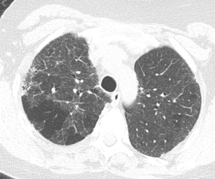 Fibrotic hypersensitivity pneumonitis. (a–c) Axial inspiratory CT scans demonstrate substantial ground-glass abnormality, mild centrilobular nodularity, and moderate mosaic attenuation, in addition to peribronchovascular and lower lung–predominant fibrosis. (d–f) Axial expiratory CT images confirm air trapping as the cause of mosaic attenuation. The degree of ground-glass abnormality, the degree of air trapping, and the peribronchovascular predominance of fibrosis would result in this case being categorized as most consistent with a nonidiopathic pulmonary fibrosis diagnosis.