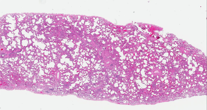 CT-histologic correlation in nonspecific interstitial pneumonia. (a) Axial CT image shows predominant ground-glass abnormality, with mild subpleural reticular abnormality. (b) Histologic image shows a diffuse homogeneous process with expansion of the alveolar septa by chronic inflammation and patchy interstitial scarring, unassociated with honeycomb change or substantial remodeling of the underlying lung architecture. In contrast to UIP, the abnormality is temporally homogeneous. (Hematoxylin-eosin stain) (Histologic image courtesy of Rosane Duarte Achcar, MD, National Jewish Health.)