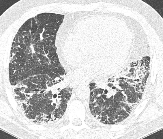 CT pattern indeterminate for usual interstitial pneumonia. (a–c) Axial inspiratory CT images demonstrate peripheral and lower lung–predominant reticular abnormality with architectural distortion, including traction bronchiectasis. However, there is slightly more ground-glass abnormality than typically seen with a confident diagnosis of a usual interstitial pneumonia pattern, and the reticular abnormality extends along the bronchovascular bundles rather than being confined to the subpleural lung.