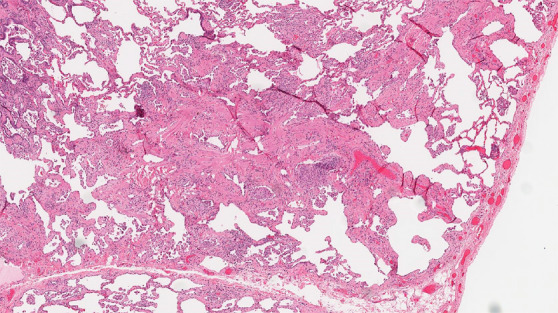 CT-histologic correlation in fibrotic hypersensitivity pneumonitis (HP). (a) Coronal CT image shows lower lung–predominant reticular and ground-glass abnormality. The findings of mosaic attenuation and peribronchovascular predominance are highly suggestive of fibrotic HP. (b) Photomicrograph from histologic examination shows centrilobular scarring compatible with fibrotic HP. (Hematoxylin-eosin stain) (c) Peribronchiolar poorly formed nonnecrotizing granulomas are also present, highly suggestive of HP. (Hematoxylin-eosin stain) (Histologic images courtesy of Rosane Duarte Achcar, MD, National Jewish Health.)