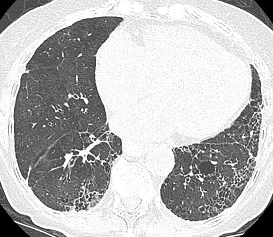 Nonspecific interstitial pneumonia. (a) Axial CT scan demonstrates fibrotic nonspecific interstitial pneumonia early in the disease course with lower lung fibrosis and ground-glass opacity with some subpleural sparing. (b) Axial CT scan 10 years later demonstrates substantial progression of the pulmonary fibrosis, which now demonstrates increased reticular abnormality, less ground-glass abnormality, and more traction bronchiectasis. Understanding the evolution of the disease by reviewing the prior imaging is critical in these cases.