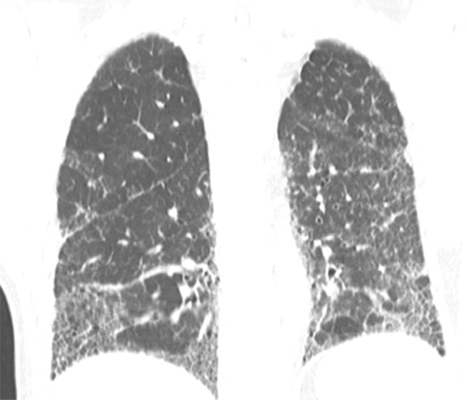 CT-histologic correlation in usual interstitial pneumonia. (a) Coronal CT image shows reticular abnormality and mild honeycombing with subpleural and lower lung predominance, typical of usual interstitial pneumonia. (b) Photomicrograph from histologic examination shows remodeling of the lung architecture by predominantly subpleural and paraseptal dense fibrosis, with scattered fibroblastic foci (blue arrow). Areas of normal lung are also seen, mainly in the centrilobular region, indicating temporal heterogeneity. (Histologic image courtesy of Rosane Duarte Achcar, MD, National Jewish Health.)