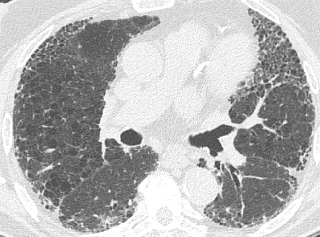 Usual interstitial pneumonia pattern. (a–d) Axial inspiratory CT images demonstrate peripheral and basilar-predominant reticular abnormality, with associated traction bronchiectasis and honeycombing. This is a usual interstitial pneumonia pattern based on Fleischner and American Thoracic Society guidelines. (e) Coronal inspiratory CT scan confirms the lower lung–predominant distribution of disease in the craniocaudal plane.